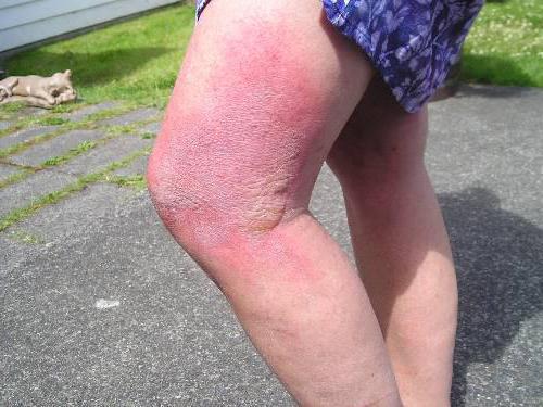 foto-2-ozhoga-ot-borshhevika